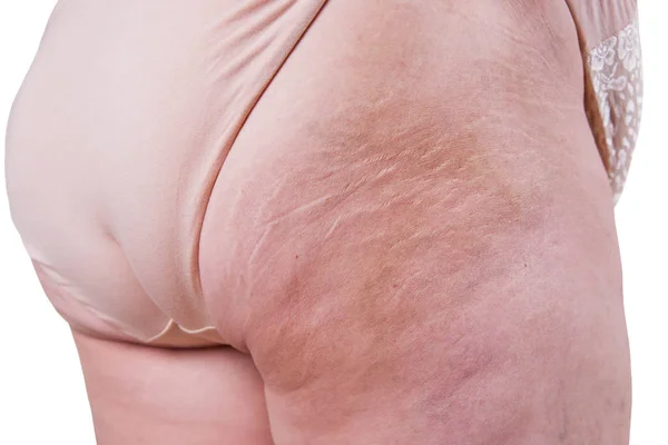 Nalgas de anciana aisladas sobre fondo blanco, obesidad cuerpo femenino con estrías — Foto de Stock