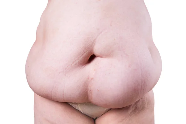 Tummy tuck, pele flácida em uma barriga gorda, conceito de cirurgia plástica isolado em fundo branco — Fotografia de Stock