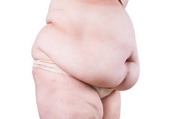 Tummy tuck, zwiotczała skóra na brzuchu tłuszczu, koncepcja chirurgii plastycznej izolowane na białym tle — Zdjęcie stockowe