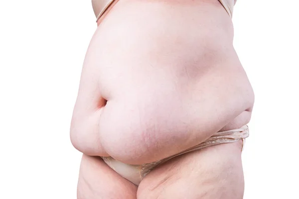 Tummy tuck, pelle flaccida su una pancia grassa, concetto di chirurgia plastica isolato su sfondo bianco — Foto Stock