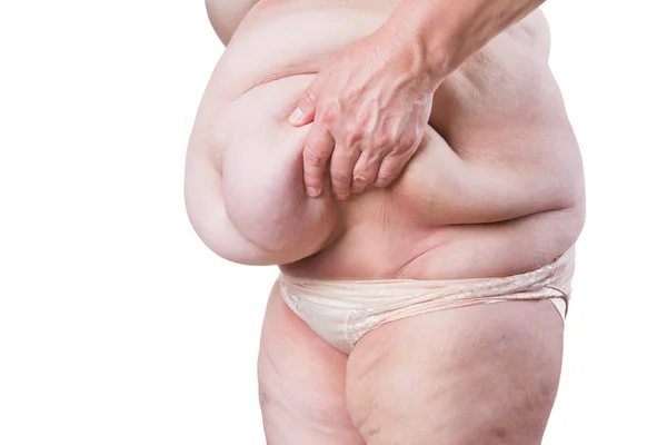 Tummy tuck, petyhüdt bőr egy kövér has, plasztikai sebészet koncepció elszigetelt fehér alapon — Stock Fotó