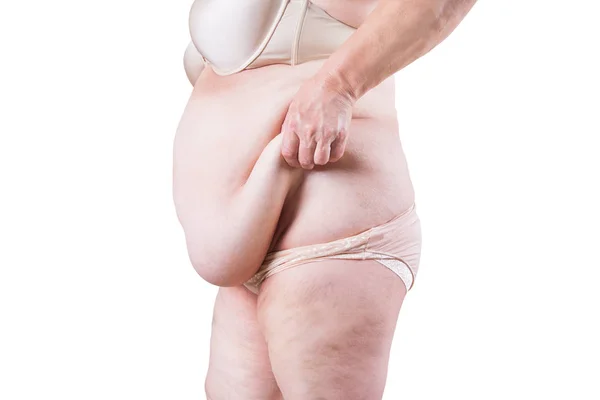 Tummy tuck, pelle flaccida su una pancia grassa, concetto di chirurgia plastica isolato su sfondo bianco — Foto Stock