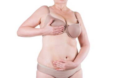 Tummy Tuck, yağlı göbek üzerinde gevşek cilt, plastik cerrahi kavramı