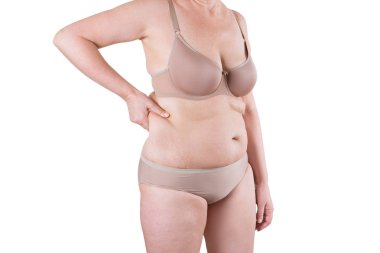 Tummy Tuck, yağlı göbek üzerinde gevşek cilt, plastik cerrahi kavramı