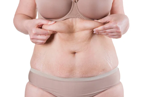 Bauchdeckenstraffung, schlaffe Haut auf dickem Bauch, Konzept der plastischen Chirurgie — Stockfoto