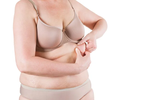 Abdominoplastia, piel flácida en un vientre gordo, concepto de cirugía plástica — Foto de Stock