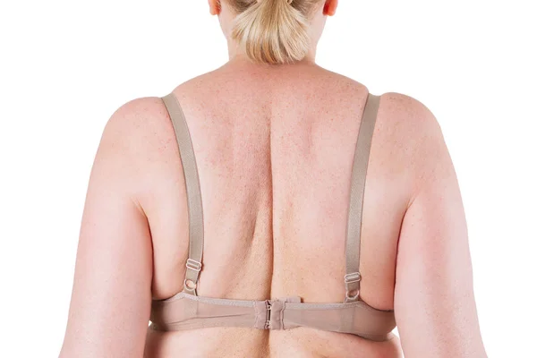 Gordura nas costas da mulher isolada no fundo branco — Fotografia de Stock