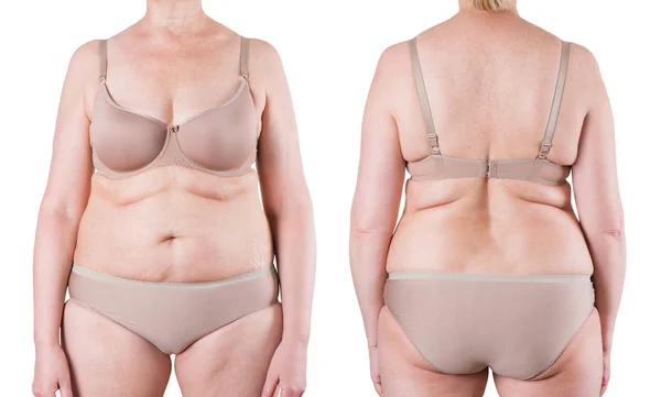 Tummy tuck, peau flasque sur un ventre gras, concept de chirurgie plastique — Photo