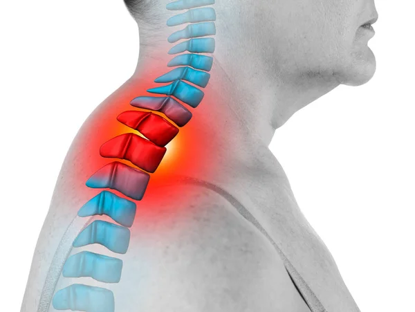 Nyaki fájdalom, isiász és gerincferdülés a nyaki gerinc izolált fehér alapon, csontkovács kezelési koncepció — Stock Fotó