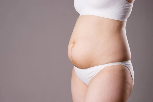 Hamilelikten sonra sarkık karın, gri arka planda şişman kadın vücudu. — Stok fotoğraf
