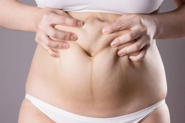 Línea de embarazo - línea nigra, abdominoplastia, cuerpo femenino con sobrepeso y vientre flácido sobre fondo gris — Foto de Stock