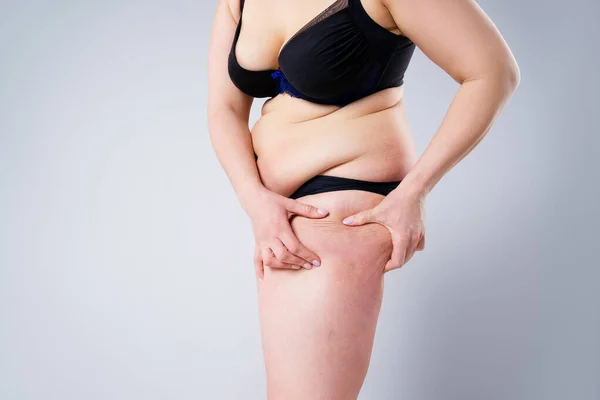 Overgewicht Vrouw Met Dikke Dijen Obesitas Vrouwelijke Benen Grijze Achtergrond — Stockfoto