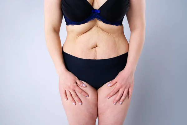 Tummy tuck, flabby skin on a fat belly, plastic surgery concept on gray background