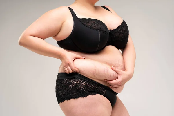 Tummy Tuck Flabby Skin Fat Belly Plastic Surgery Concept Gray — Stock Photo, Image