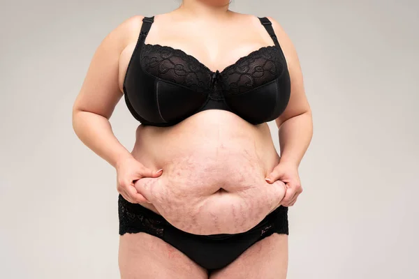 Tummy Tuck Pelle Flaccida Una Pancia Grassa Concetto Chirurgia Plastica — Foto Stock