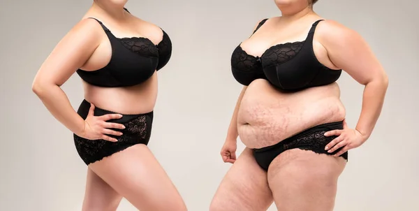 Cuerpo Mujer Antes Después Pérdida Peso Sobre Fondo Gris Concepto —  Fotos de Stock