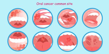 oral cancer commom site on the blue background clipart