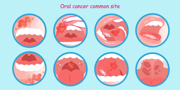 Oral Cancer Commom Site Blue Background — Stock Vector