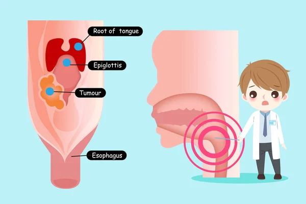 Médico Con Concepto Cáncer Oral Fondo Azul — Archivo Imágenes Vectoriales