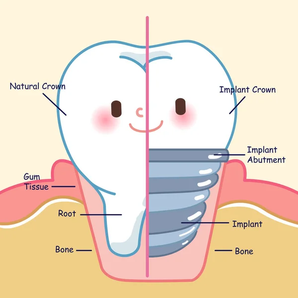 Söta Tecknade Tänder Med Implantat Gul Bakgrund — Stock vektor