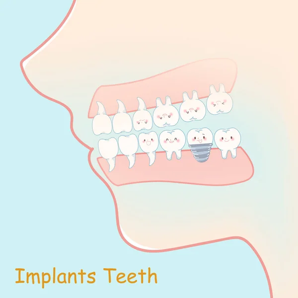 Tooth Implants Concept Blue Background — Stock Vector