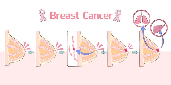 Cartoon Breast Cancer White Background — Stock Vector