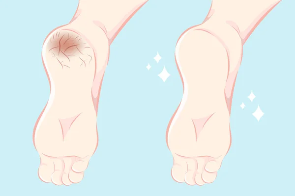 Pieds Dessin Animé Avec Peau Sèche Avant Après Traitement — Image vectorielle