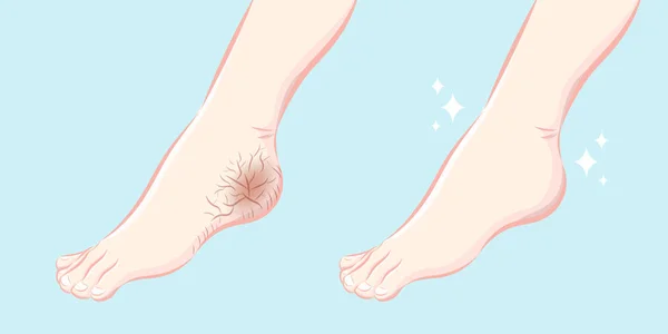 Cartoon Füße Mit Trockener Haut Vor Und Nach Der Behandlung — Stockvektor