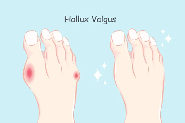 Ilustrace Normální Noha Hallux Valgus — Stockový vektor