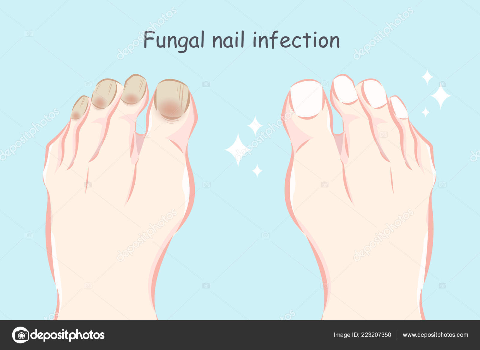 kezelés fungi nail foot medicine)
