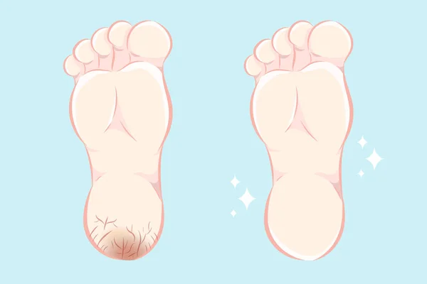 Cartoon Feet Dry Crack Skin Treatment — Stock Vector