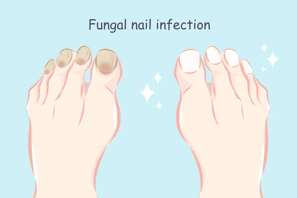 真菌性爪感染前に と治療後の足 — ストックベクタ
