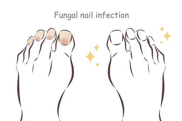 Nohy Infekce Mykotických Nehtů Před Léčbě — Stockový vektor