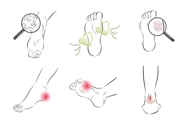 足のすべての種類のスキンケアの問題セット — ストックベクタ