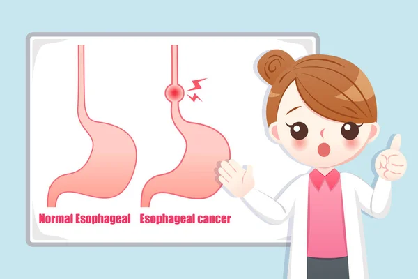 Woman Doctor Teach Medical Knowledge Esophageal Cancer — Stock Vector