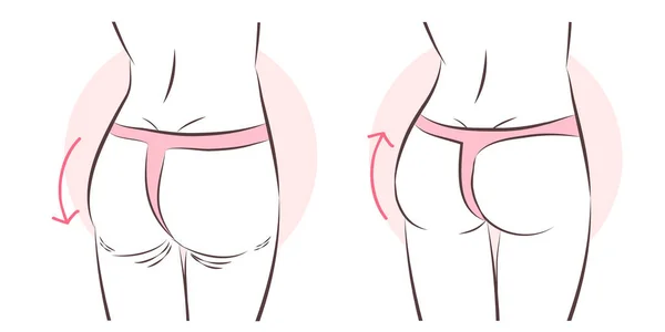 https://st4.depositphotos.com/11088892/25421/v/450/depositphotos_254219638-stock-illustration-butt-implant-before-and-after.jpg