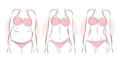  Liposuction önce ve sonra kadın