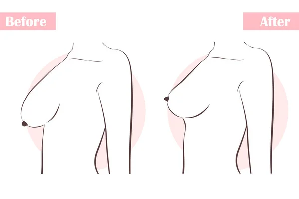 Flicka med bröst plastik kirurgi — Stock vektor