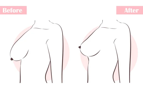 Breast lift line icon. Female body lift vector - Stock Illustration  [48773402] - PIXTA