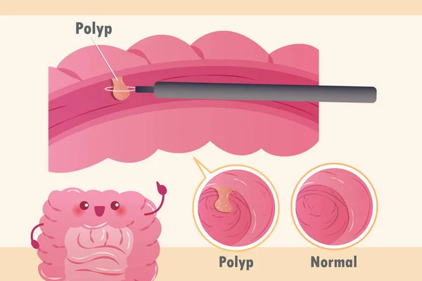 Cáncer colorrectal — Archivo Imágenes Vectoriales