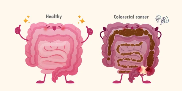 Cancer colorectal — Image vectorielle