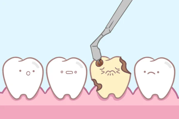 Tooth drilled by dental drill — Stock Vector