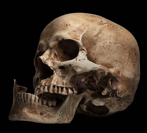 Bocca Aperta Cranio Mascella Rotta Isolato Sfondo Nero — Foto Stock