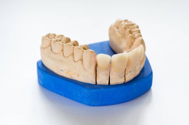 Diş hekimi laboratuvar ofis - diş alçı model yakın çekim. Alçı protez porselen dişleri beyaz arka plan üzerinde - kopya alanı izole