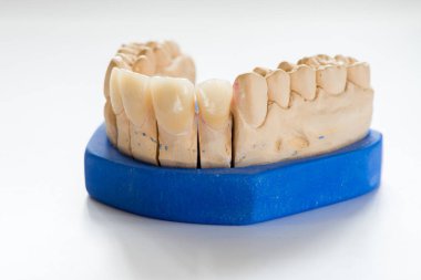 Diş hekimi laboratuvar ofis - diş alçı model yakın çekim. Alçı protez porselen dişleri beyaz arka plan üzerinde - kopya alanı izole