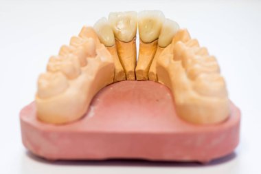 Diş hekimi laboratuvar ofis - diş alçı model yakın çekim. Alçı protez porselen dişleri beyaz arka plan üzerinde - kopya alanı izole
