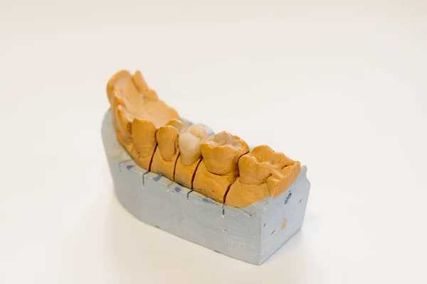 Dental Gypsum Model Dentist Laboratory Office Close Gypsum Dentures Porcelain — Stock Photo, Image