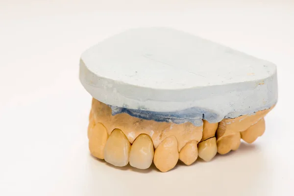 牙科石膏模型在牙医实验室办公室 石膏假牙与瓷牙查出在白色背景 拷贝空间 — 图库照片