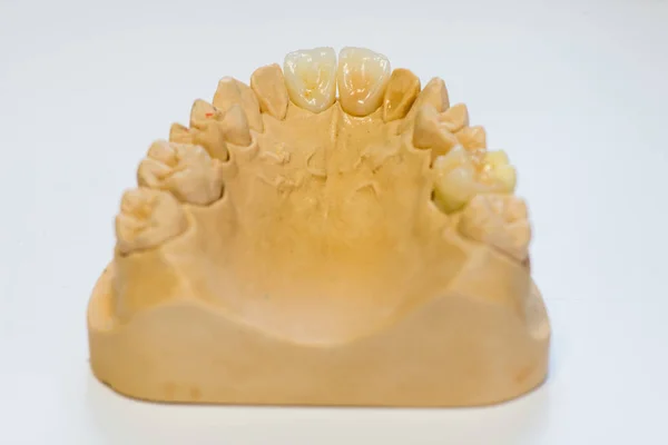 Modelo Gesso Dentário Consultório Laboratório Dentista Close Dentaduras Gesso Com — Fotografia de Stock