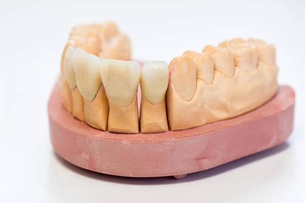 Modelo Yeso Dental Consultorio Del Laboratorio Del Dentista Primer Plano —  Fotos de Stock